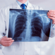 Imagem mostra raio x do pulmão 